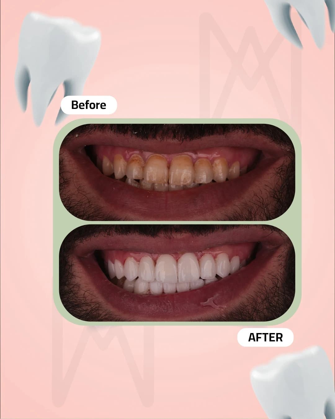 Teeth Whitening Transformation