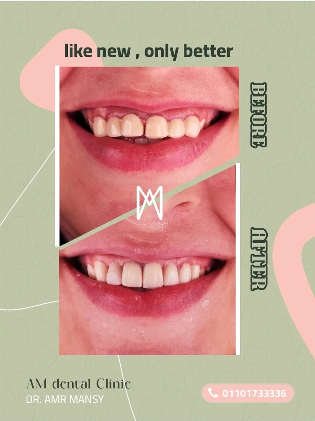 Premium Custom Veneers Makeover