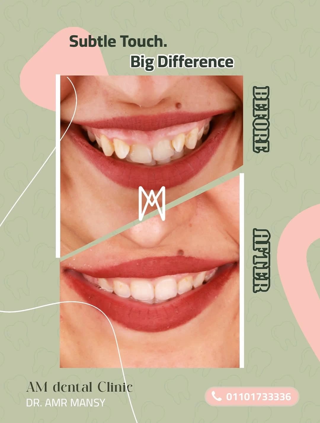 Major Orthodontic Smile Correction