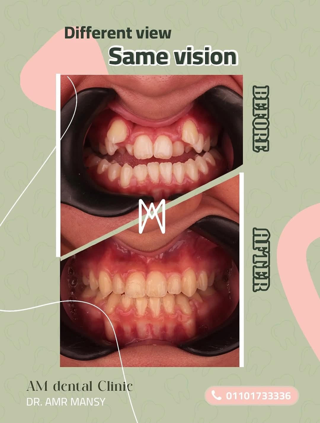 Full Smile Alignment With Braces