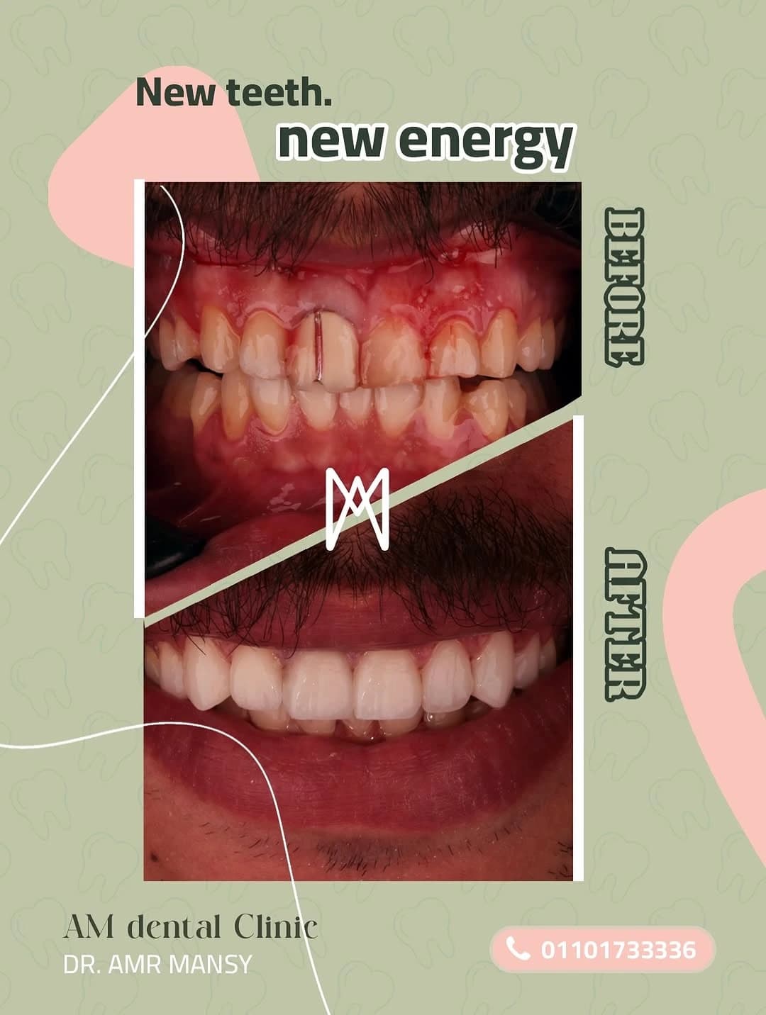 Complete Veneers Aesthetic Upgrade
