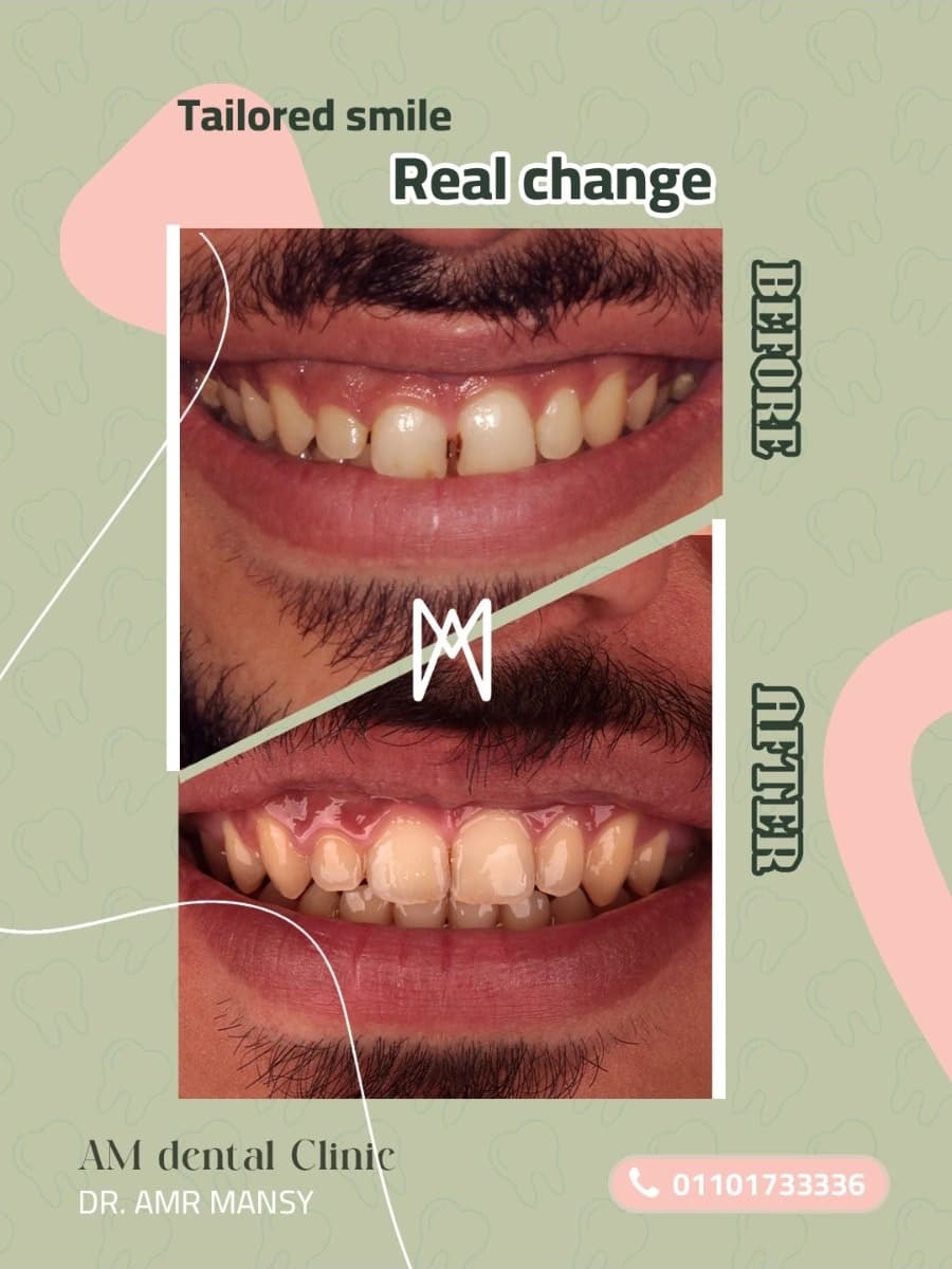 Orthodontic Smile Enhancement