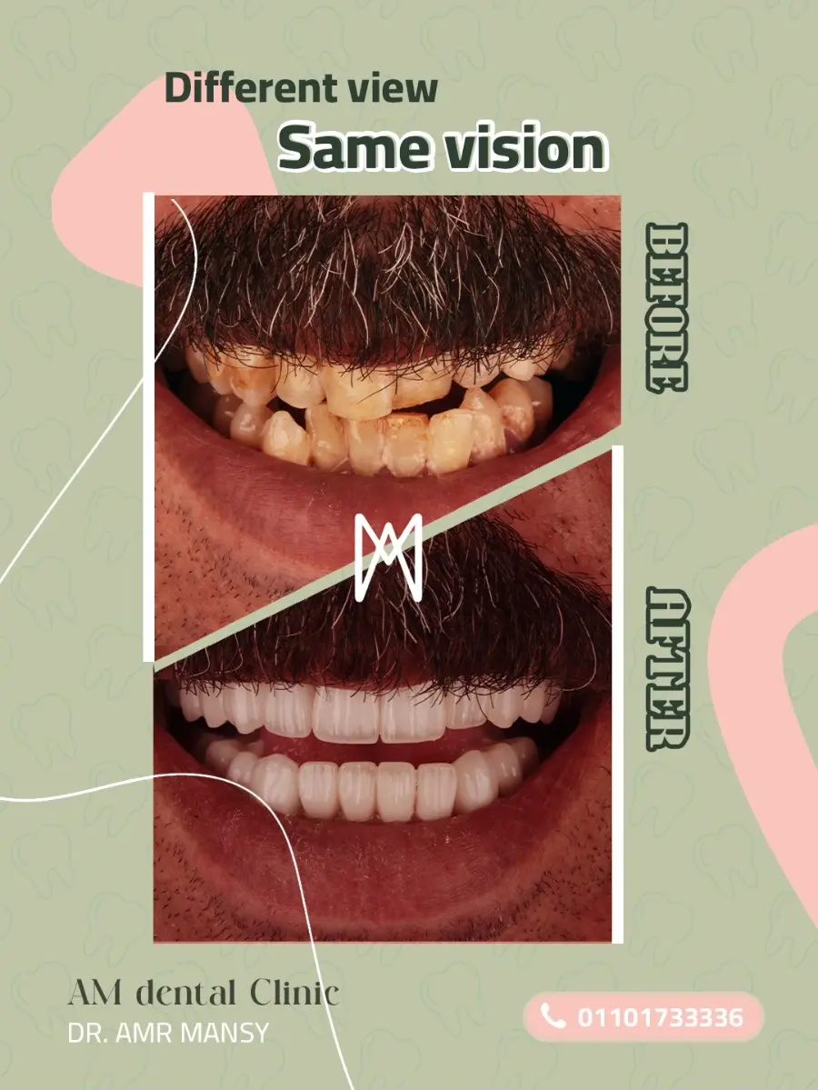 Natural-Look Veneers Design